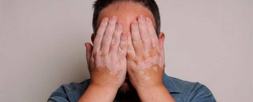 vitiligo tratmientos sintomas antienvejecimiento medicina bogota