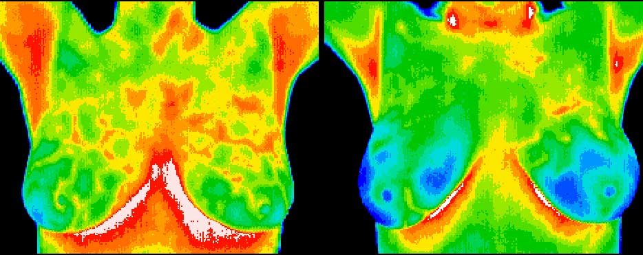 termografia mamaria mamografia cancer de seno prevencion colombia