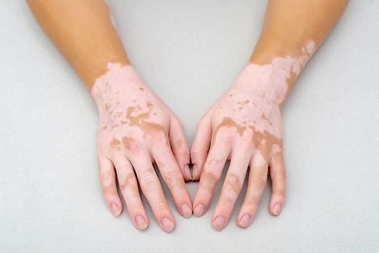 vitiligo tratmientos sintomas antienvejecimiento medicina bogota