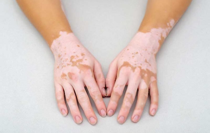 vitiligo tratmientos sintomas antienvejecimiento medicina bogota