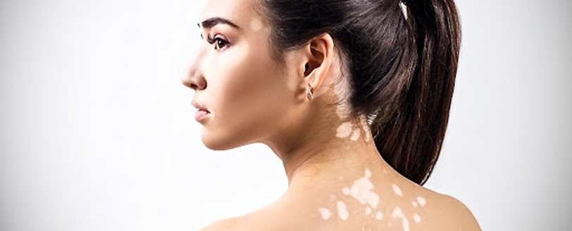 vitiligo tratmientos sintomas antienvejecimiento medicina bogota