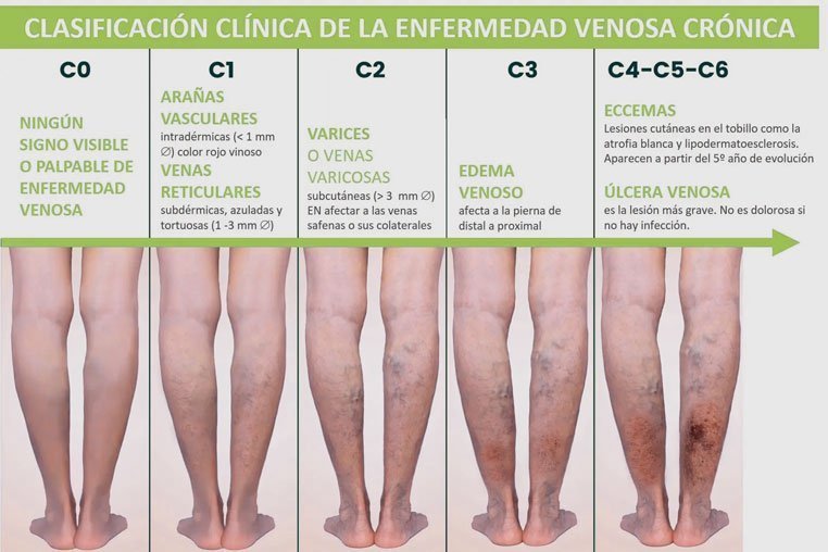 venas ozonoterapia bogota